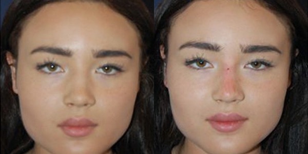 Non-Surgical Rhinoplasty Before & After