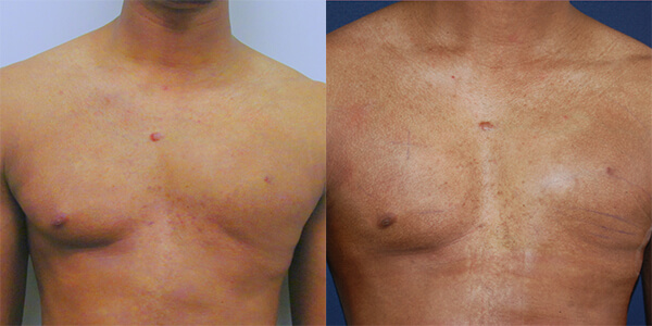 Pectoral Implant London Plastic Surgery