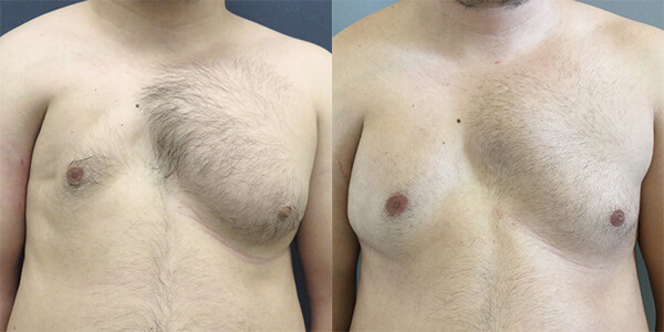 Pectoral Implant London Plastic Surgery