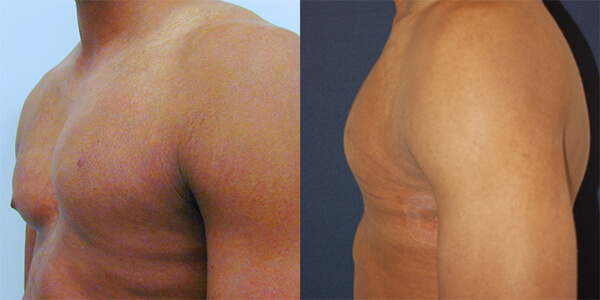 Pectoral Implant London Plastic Surgery