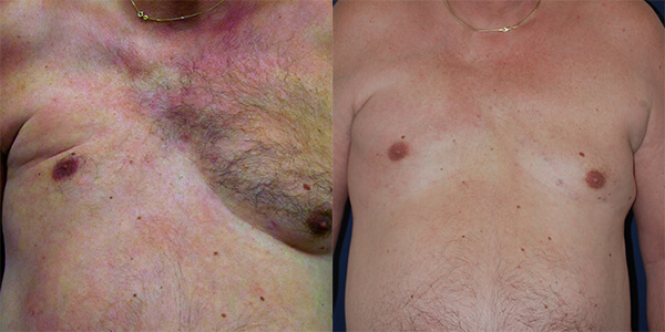 Pectoral Implant London Plastic Surgery