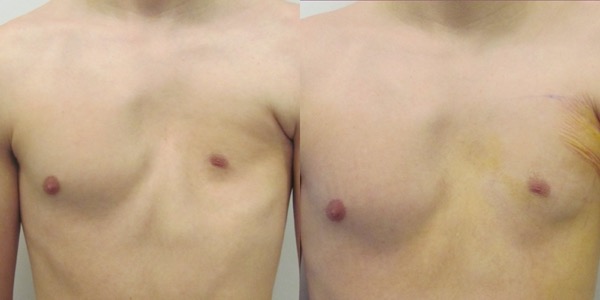 Pectoral Implants Before & After