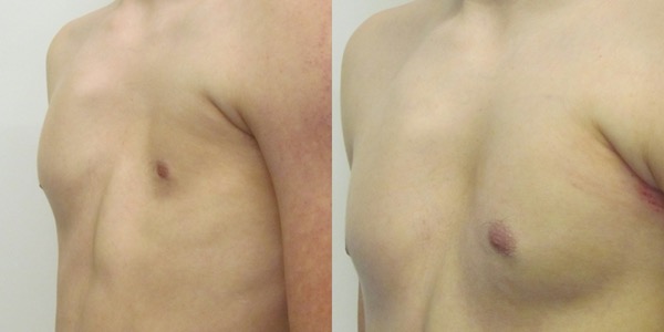 Pectoral Implants Before & After