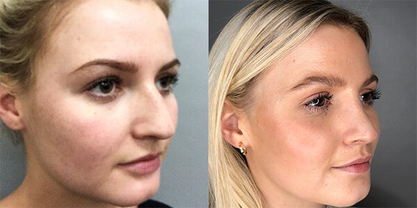 Rhinoplasty 111 Harley St.