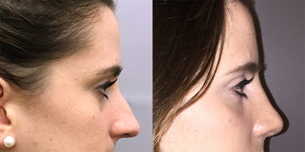 Rhinoplasty 111 Harley St.