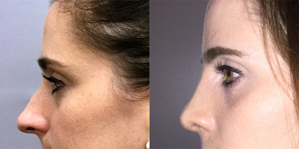 Rhinoplasty 111 Harley St.