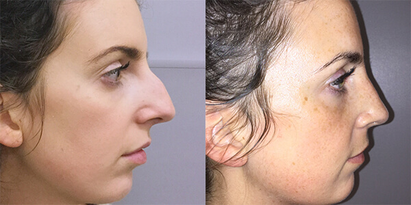 Rhinoplasty 111 Harley St.