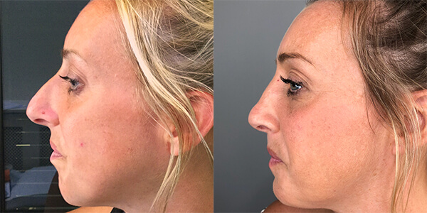 Rhinoplasty 111 Harley St.