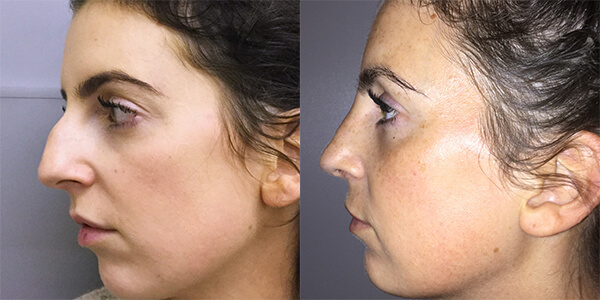 Rhinoplasty 111 Harley St.