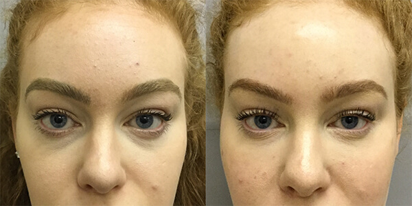 Rhinoplasty 111 Harley St.