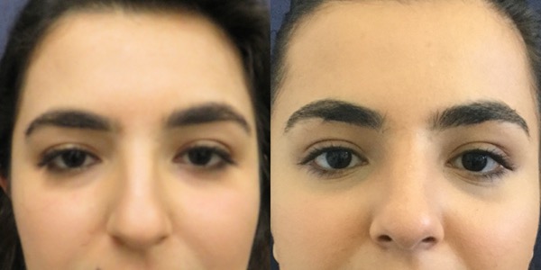 Rhinoplasty Before & After