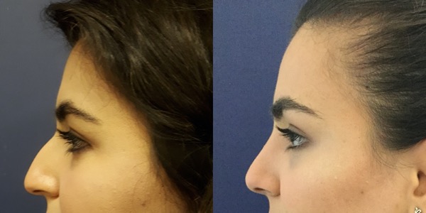 Rhinoplasty Before & After