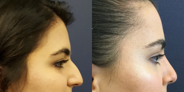 Rhinoplasty Before & After