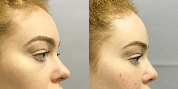 Rhinoplasty 111 Harley St.