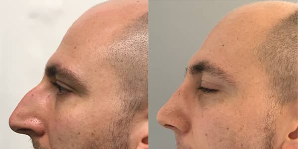 Rhinoplasty London Plastic Surgery