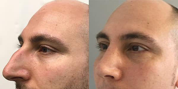 Rhinoplasty London Plastic Surgery