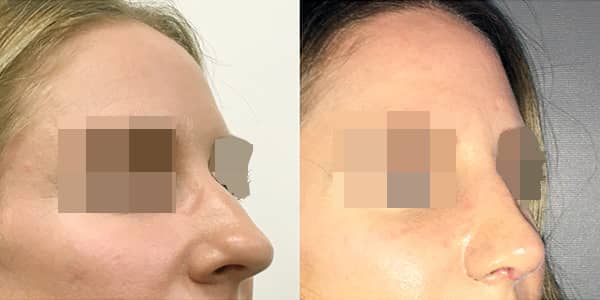 Rhinoplasty London