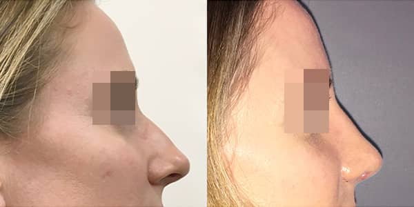 Rhinoplasty London