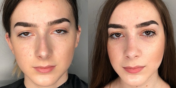 Septorhinoplasty Before & After