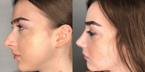 Septorhinoplasty Before & After