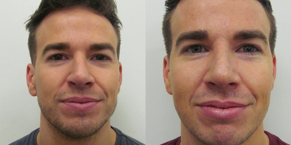 Septorhinoplasty Before & After