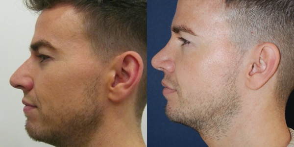 Septorhinoplasty Before & After