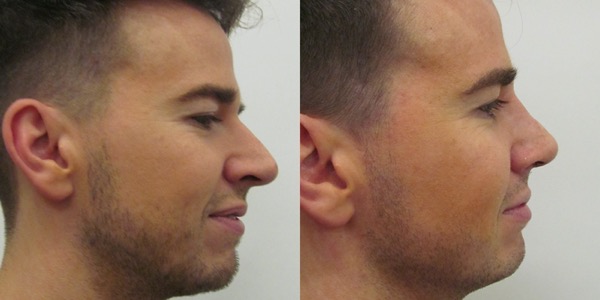 Septorhinoplasty Before & After