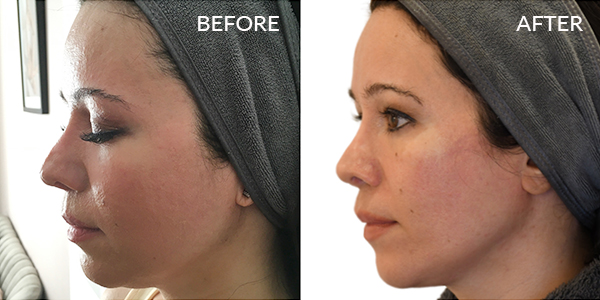 thermage-flx-before-and-after-London