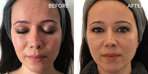 thermage-flx-before-and-after-London