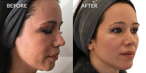 thermage-flx-before-and-after-London