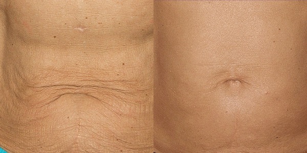 Thermage Skin Tightening Before & After