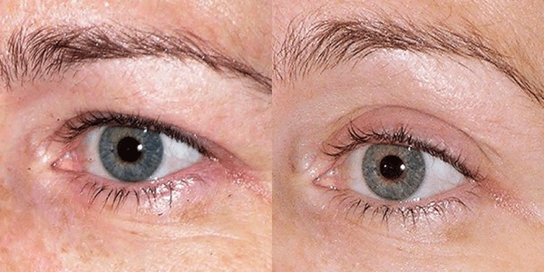 Thermage Skin Tightening Before & After