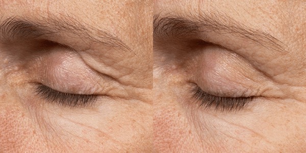 Thermage Skin Tightening Before & After