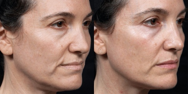 Thermage Skin Tightening Before & After