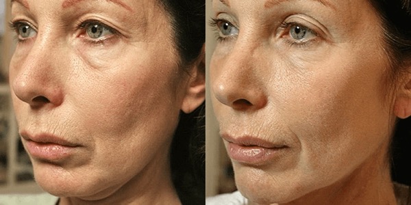 Thermage Skin Tightening Before & After