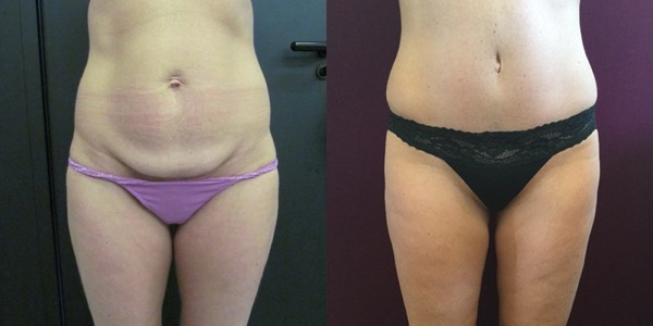 Tummy Tuck Before & After