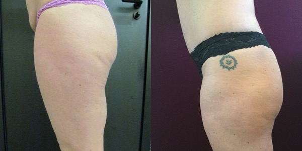 Tummy Tuck Before & After