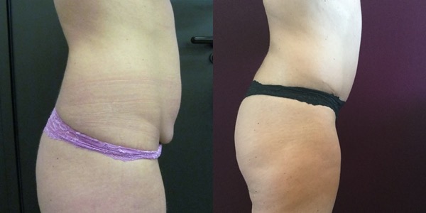 Tummy Tuck Before & After