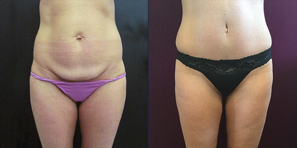 Tummy Tuck 111 Harley St.