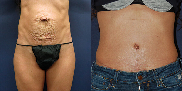 Tummy Tuck 111 Harley St.