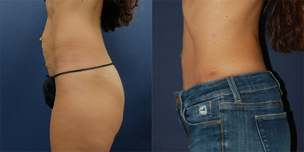 Tummy Tuck 111 Harley St.