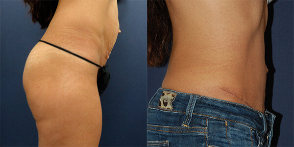 Tummy Tuck 111 Harley St.