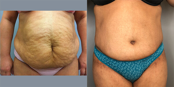 Tummy Tuck 111 Harley St.