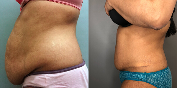 Tummy Tuck 111 Harley St.