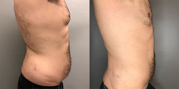 Tummy Tuck 111 Harley St.