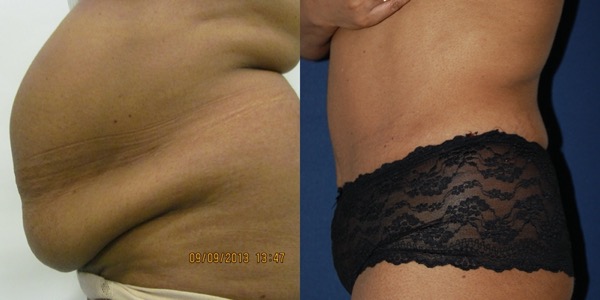 Tummy Tuck Before & After