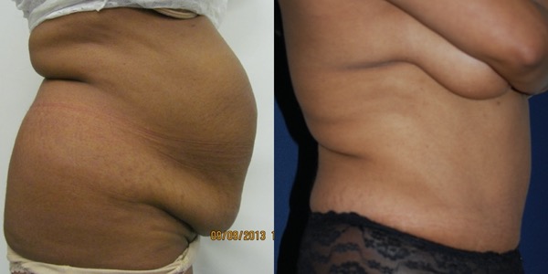 Tummy Tuck Before & After