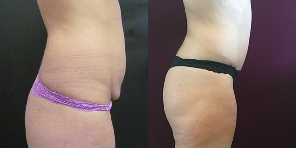 Tummy Tuck 111 Harley St.