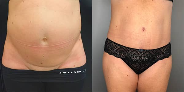 Tummy Tuck 111 Harley St.