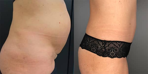 Tummy Tuck 111 Harley St.